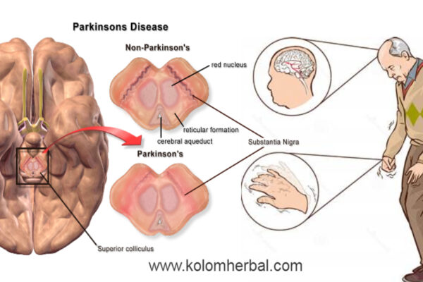 Gejala, Penyebab, dan Pengobatan Penyakit Parkinson