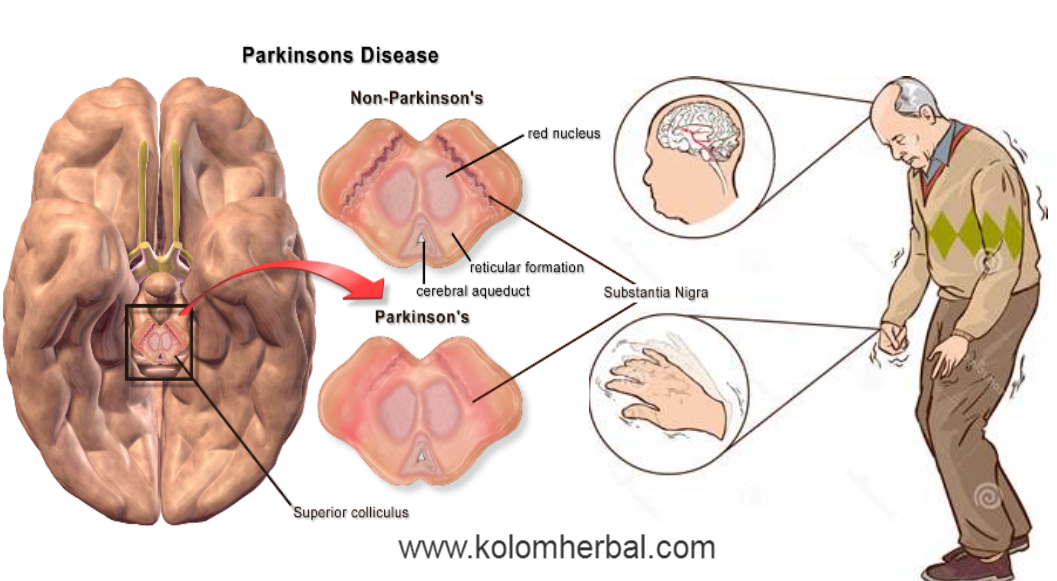 Gejala, Penyebab, dan Pengobatan Penyakit Parkinson